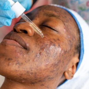 Acne Facial Lagos, Acne Treatment Facial, Deep Cleansing Facial, Facial for Oily Skin, Blackhead Removal Facial, Acne Scar Treatment, Professional Facial Lagos, Clear Skin Treatment, Skincare Spa Lagos, Acne Skincare Specialist.