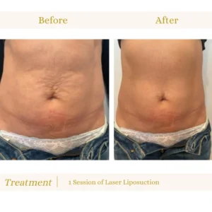 I-LIPO Lagos, Non-Surgical Fat Reduction, Laser Lipo Treatment, Body Contouring Lagos, Body Sculpting Treatment, Inch Loss Programme, Fat Reduction Therapy, Non-Invasive Slimming, Medical Aesthetic Treatments, Body Shaping Lagos
